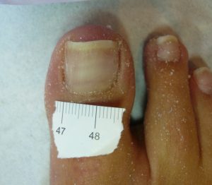cure of toenaiil fungus affecting one toenail