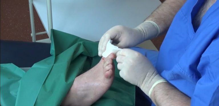 Ingrown toenail surgery