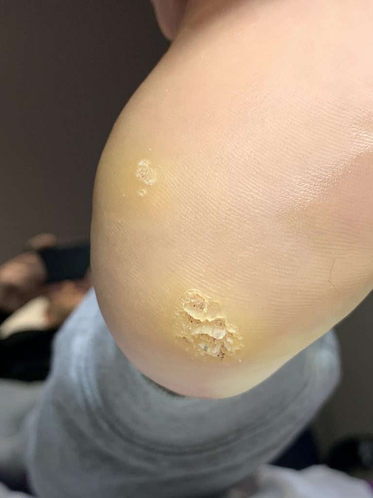 Needling Treatment for Stubborn Verruca Multiple Verruca A&A