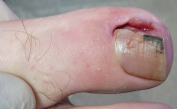 Ingrown Toe Nail Treatment & Surgery | A&A Podiatrists & Chiropodists