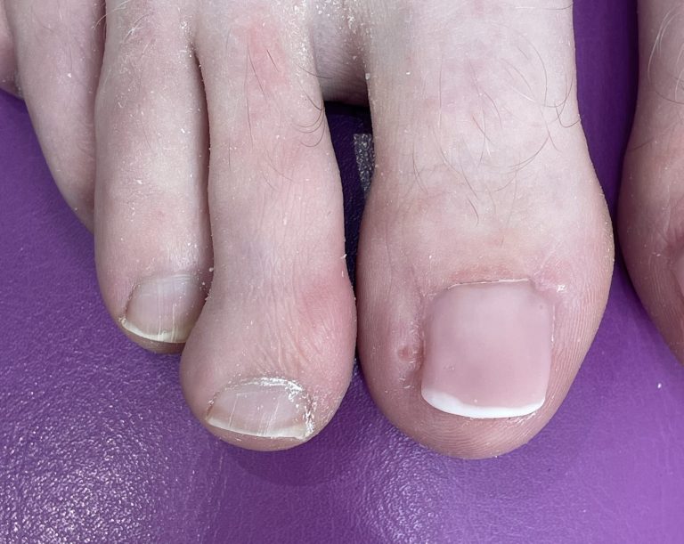 The same toenail after Pedique nail replacement