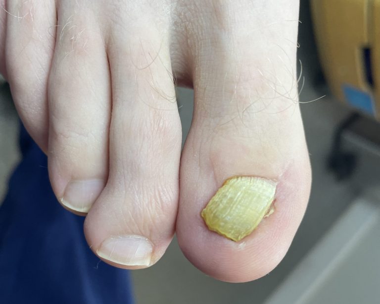 Thickened, discoloured toenail before Pedique nail replacement