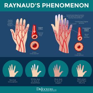 Diagram illustrating the phases of Raynaud's phenomenon, showing how blood flow is restricted and then returns.