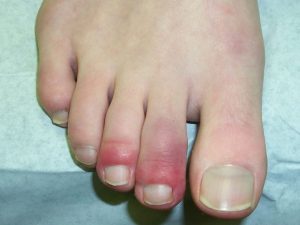 A picture of a foot showing two toes that are red and inflamed with a chilblain