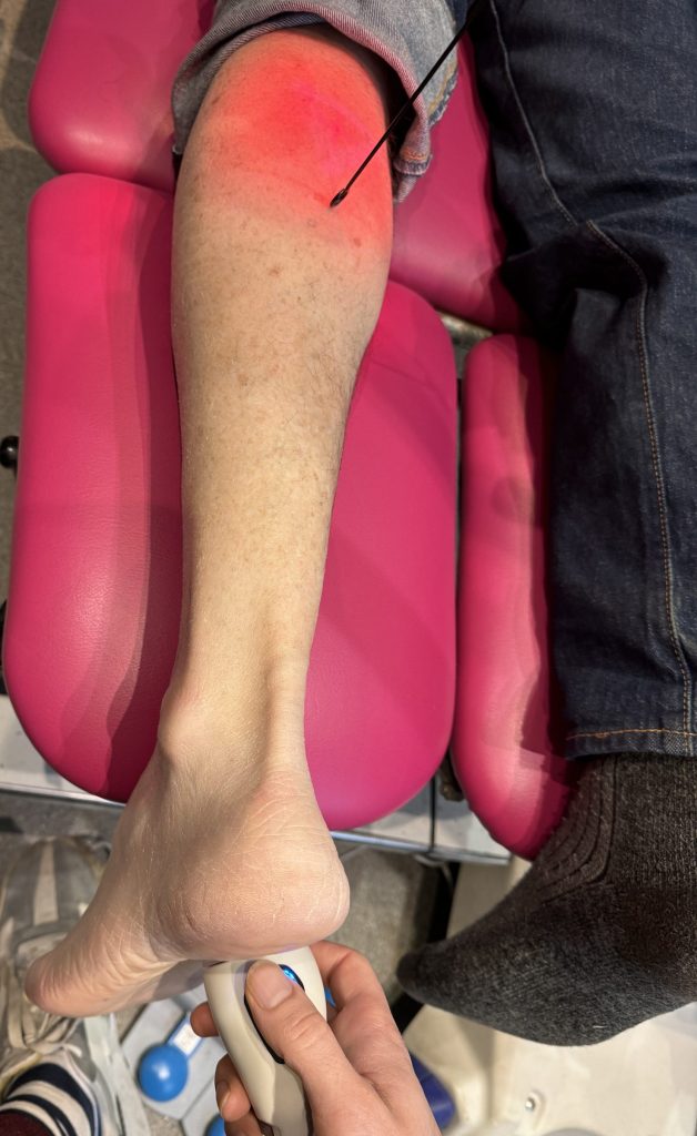 Laser treatment applied to the heel and the calf at the same time, for plantar fasciitis