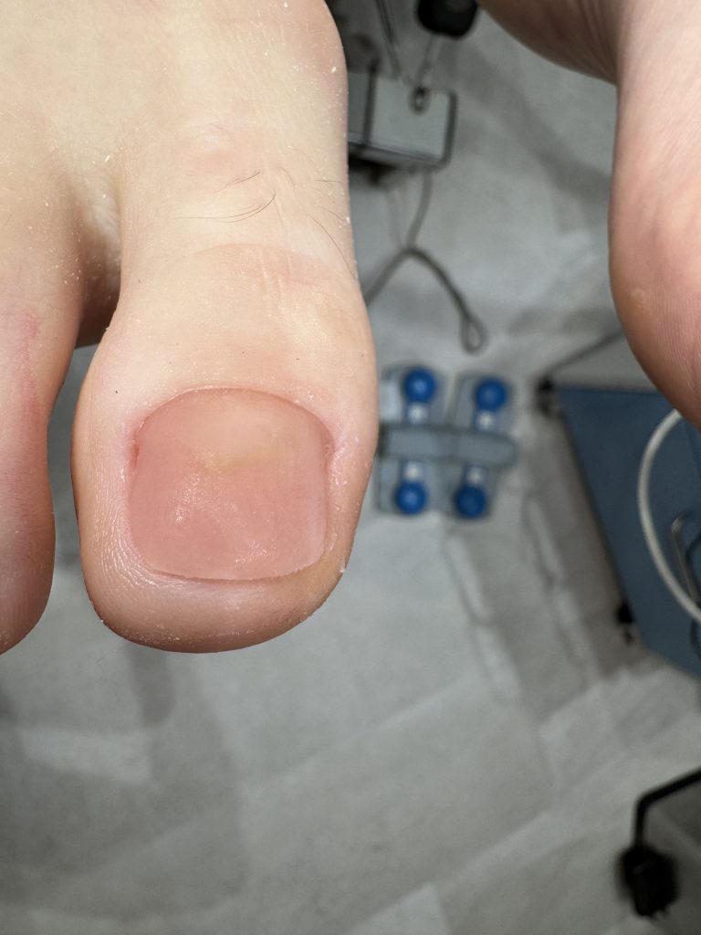 Toenail after ToeFlex nail replacement