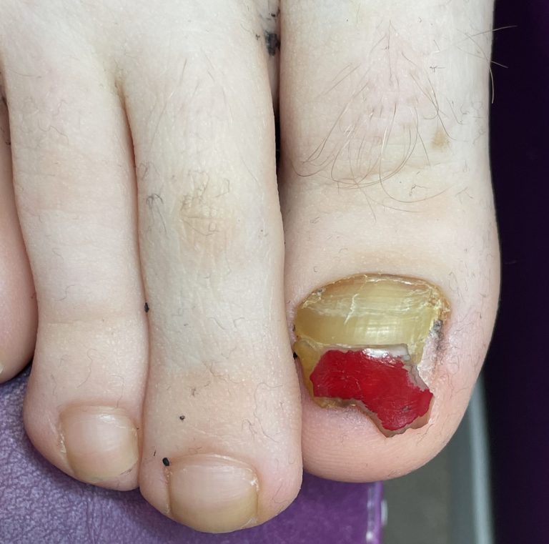 Damaged toenail before Pedique nail replacement