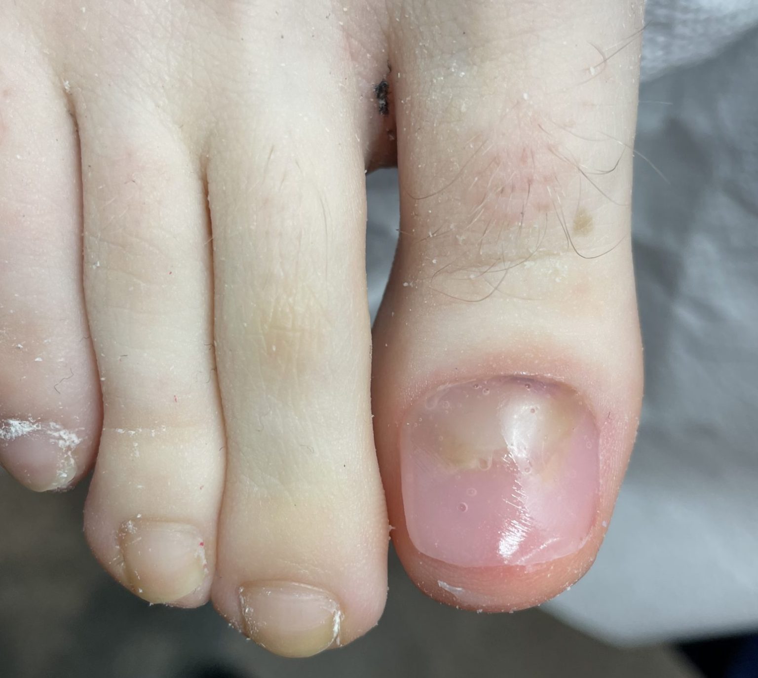 The same toe after Pedique nail replacement