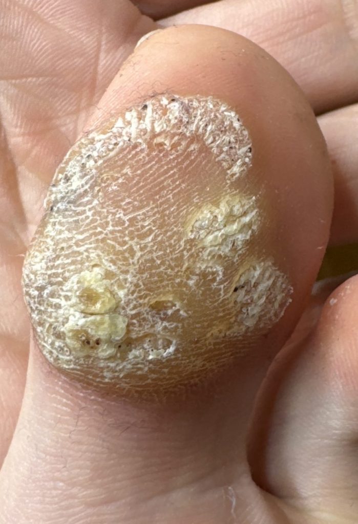 Verruca on the sole before Swift treatment
