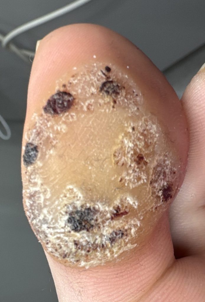 The same verruca at the second Swift treatment