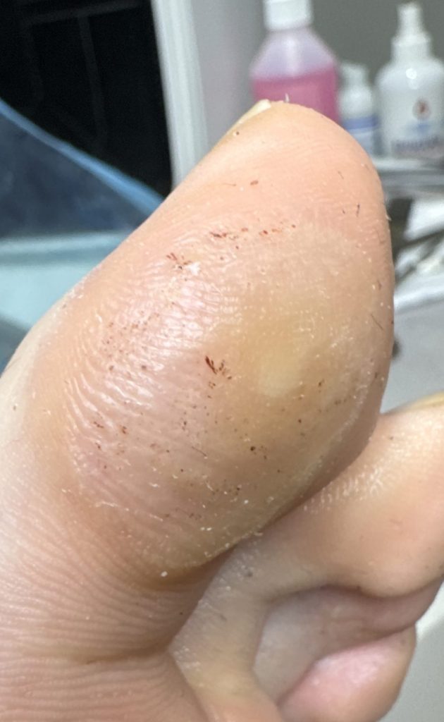 The same foot after the hard skin was removed, looking much better