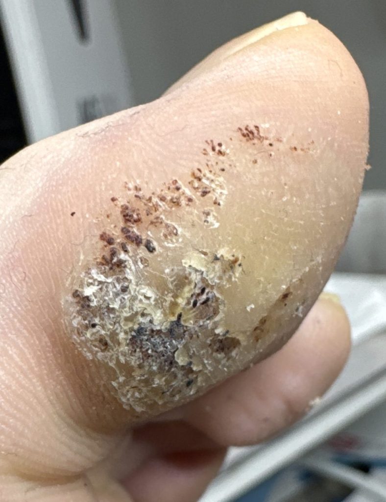 The same verruca a month later, with thick hard skin still covering it