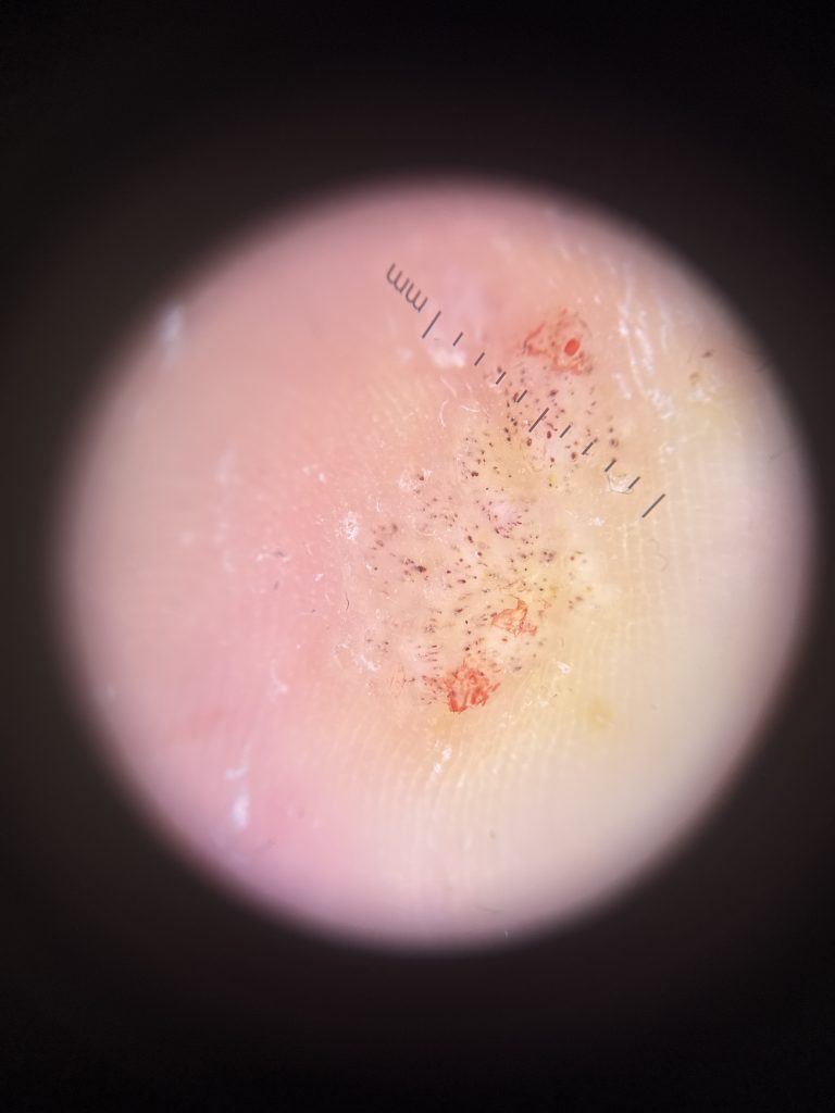 Dermatoscope image of a verruca in January 2026, after the hard skin was reduced