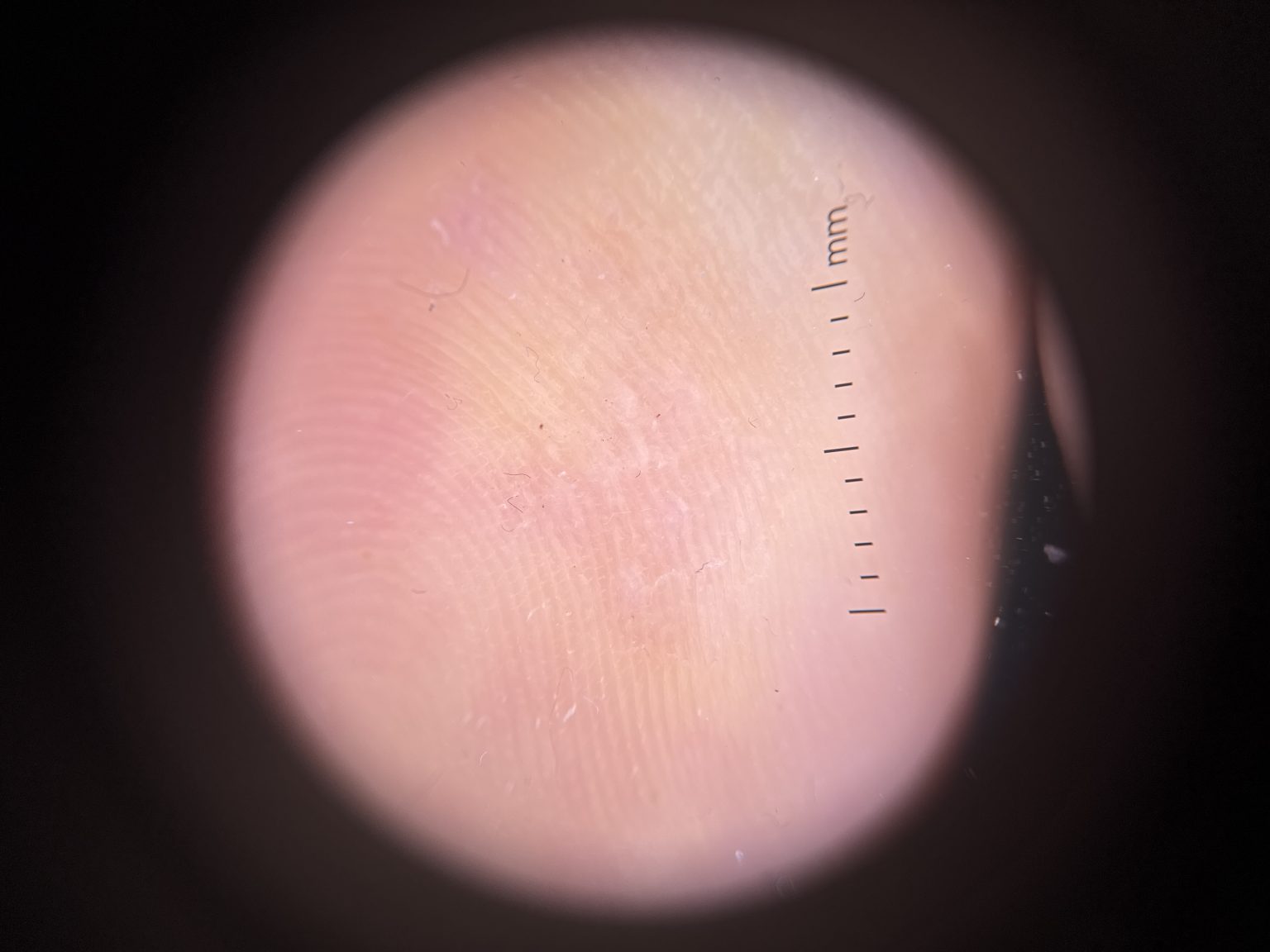Dermatoscope image of the same area in March 2026