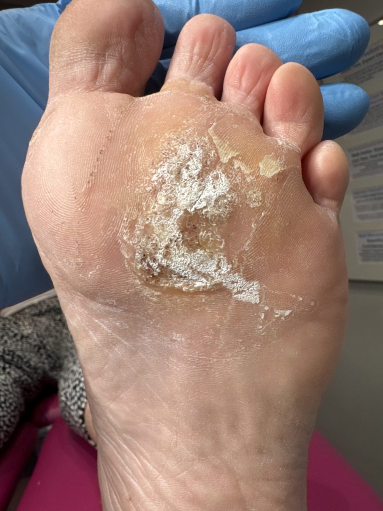 Case 3: verruca on the ball of the foot before Swift treatment