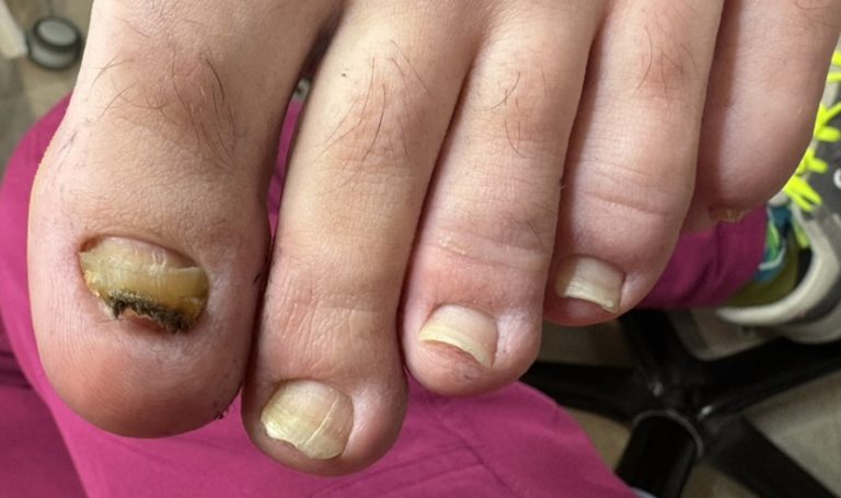 Damaged toenail on a man before ToeFlex nail replacement