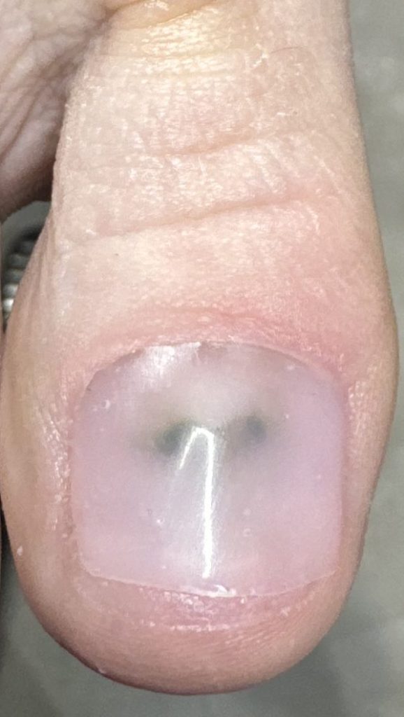 The same toenail after Pedique nail replacement, without varnish