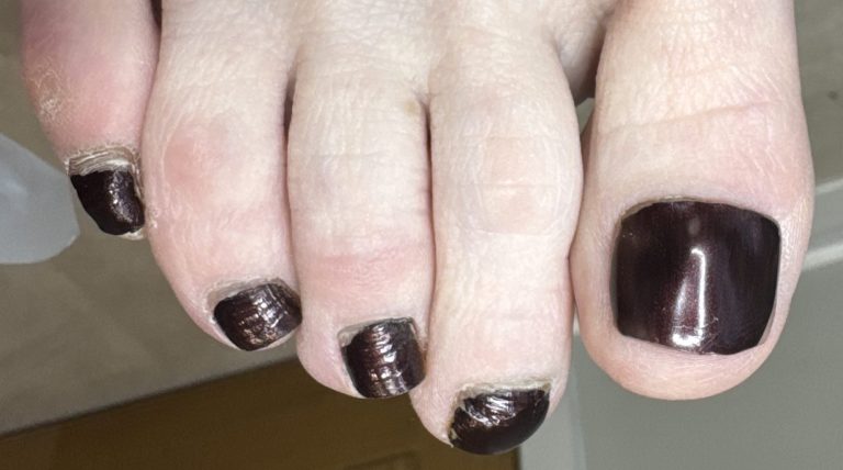 Toes after Pedique nail replacement with dark nail varnish applied