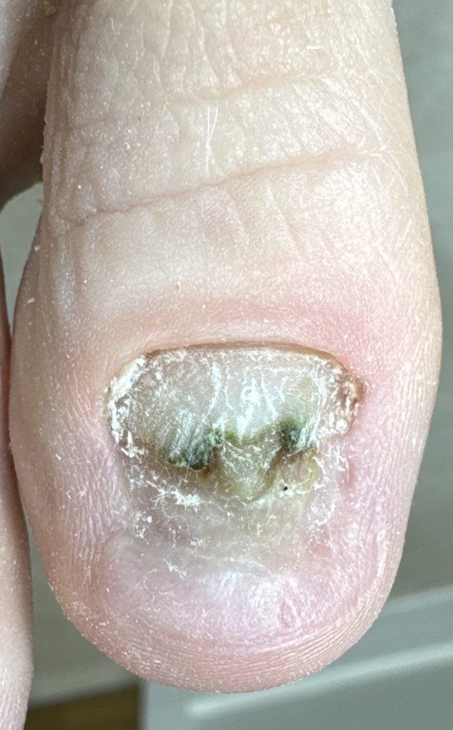 Damaged, discoloured toenail before Pedique nail replacement