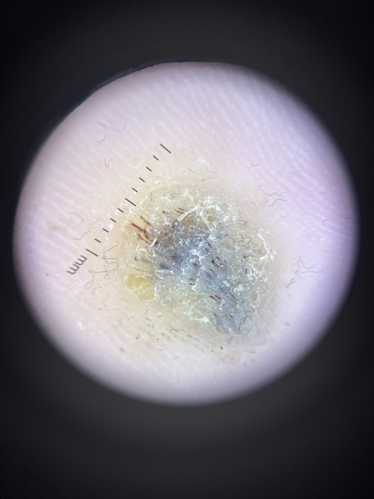 Dermatoscope image of the verruca before treatment