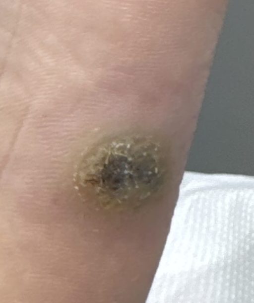 The foot with a verruca before any treatment