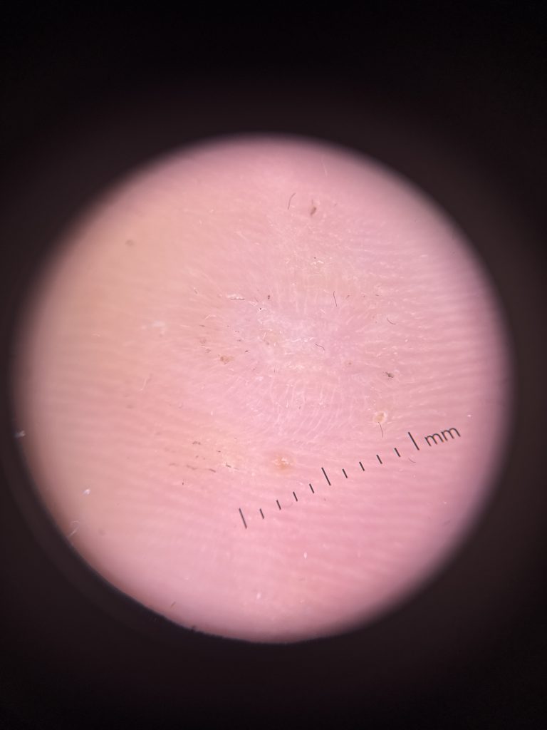 Dermatoscope close-up of the same area, resolved