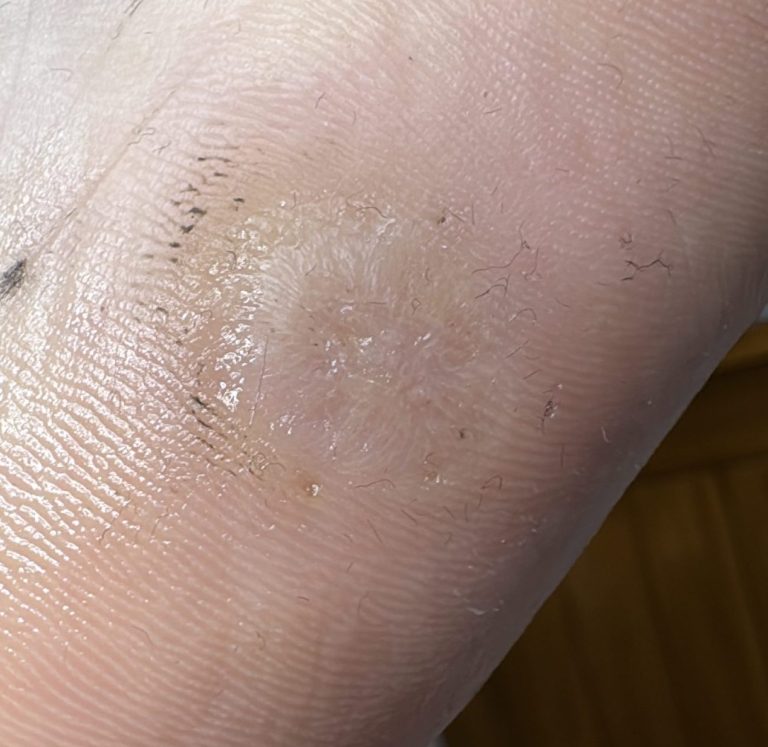 The same foot after the hard skin was removed