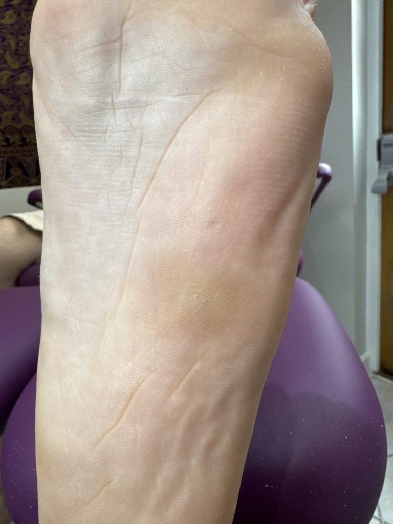 Case 2: the same foot six months after four Swift treatments, resolved