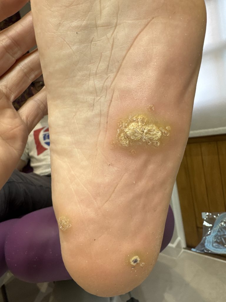 Case 2: verruca on the sole of the foot before Swift treatment