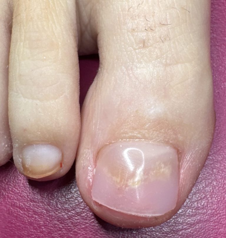 The same toe after Pedique nail replacement