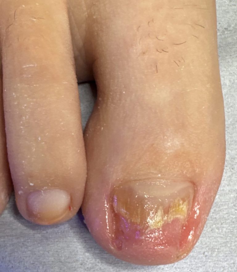 Damaged toenail before Pedique nail replacement