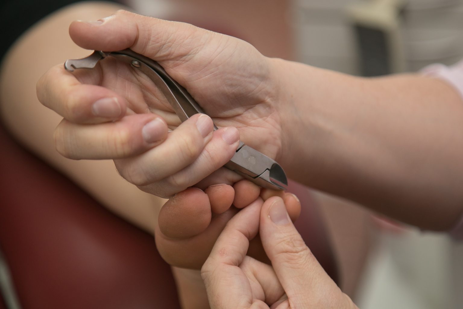 Ingrown toenails