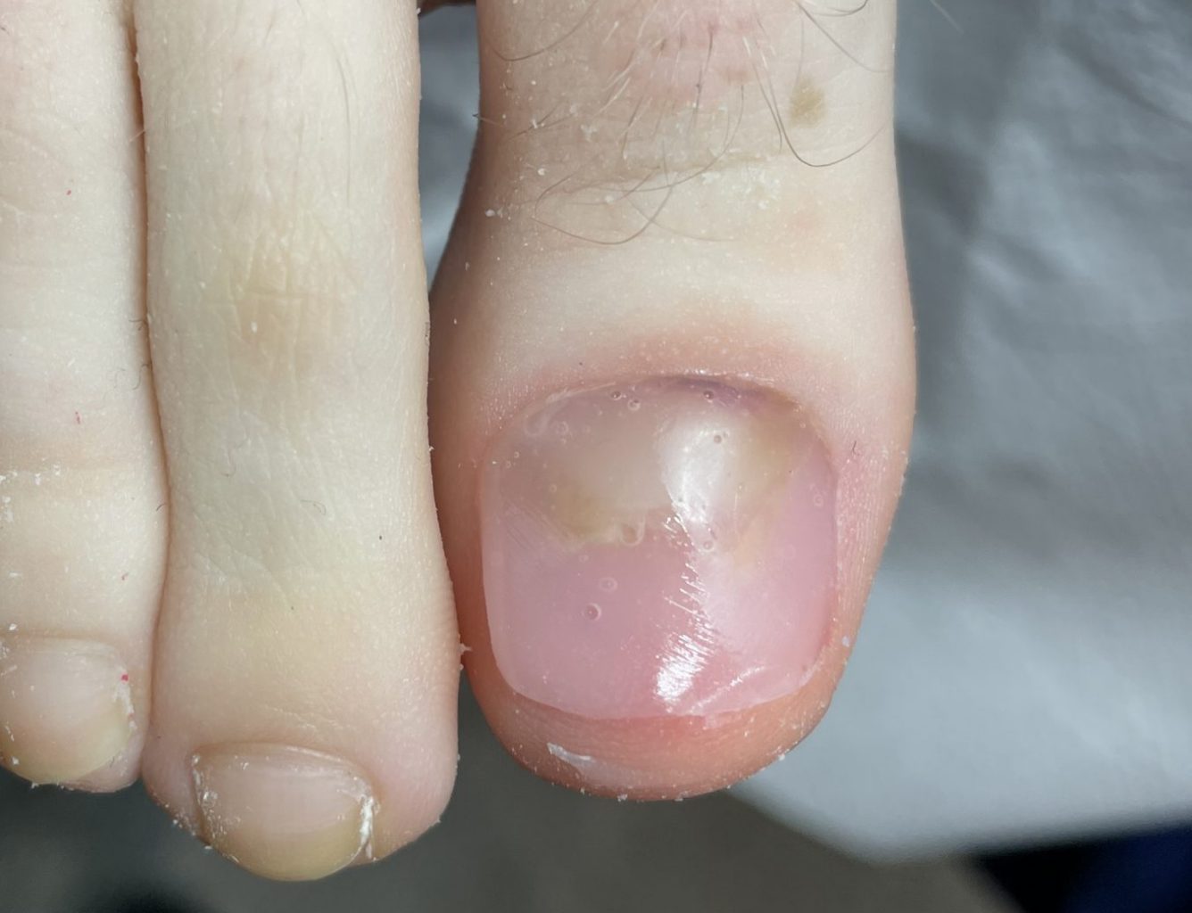 Toenail reconstruction